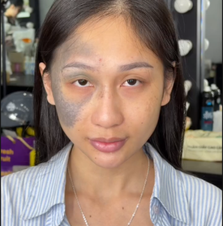 Kỹ thuật triệt sắc cho da chàm nám, da khuyết điểm